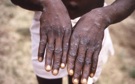 RED ALERT: Global Alarm over Ultra-Deadly Monkeypox strain Crossing Borders