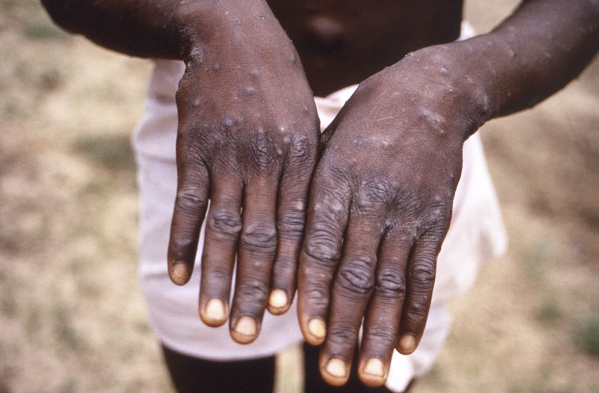 Ghana activates emergency response to combat Mpox