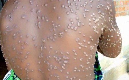 Ghana's Mpox Cases Surge to 234 with 16 New Infections Reported