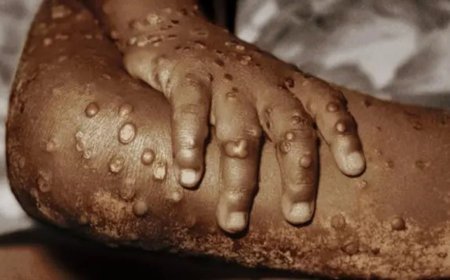 Mpox Outbreak in Ghana Takes a Deadly Turn: First Death Recorded