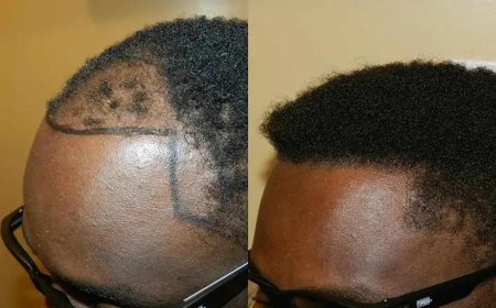 Ghana Gets Ready for Hair Transplants: UGMC to Launch Service by Year-End