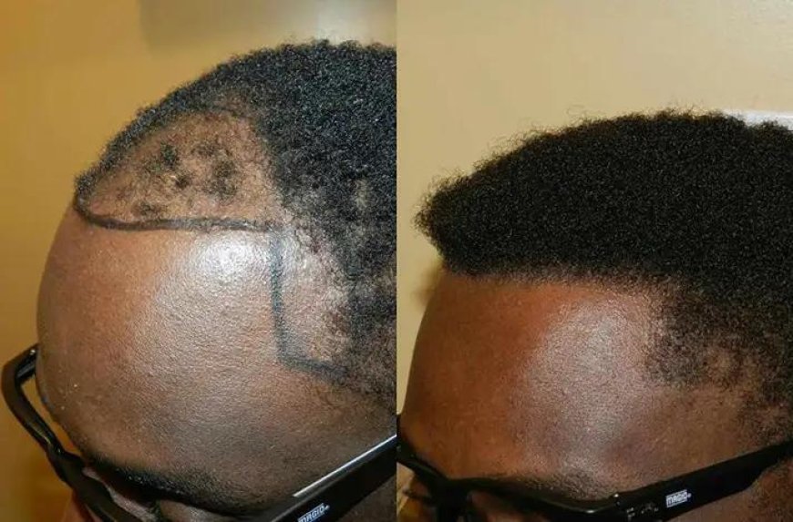 Ghana Gets Ready for Hair Transplants: UGMC to Launch Service by Year-End