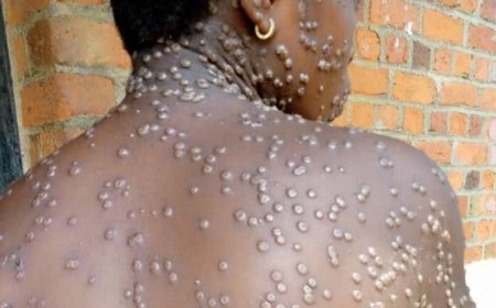 Ghana's Mpox Outbreak Worsens: 302 Cases, 20 New Infections