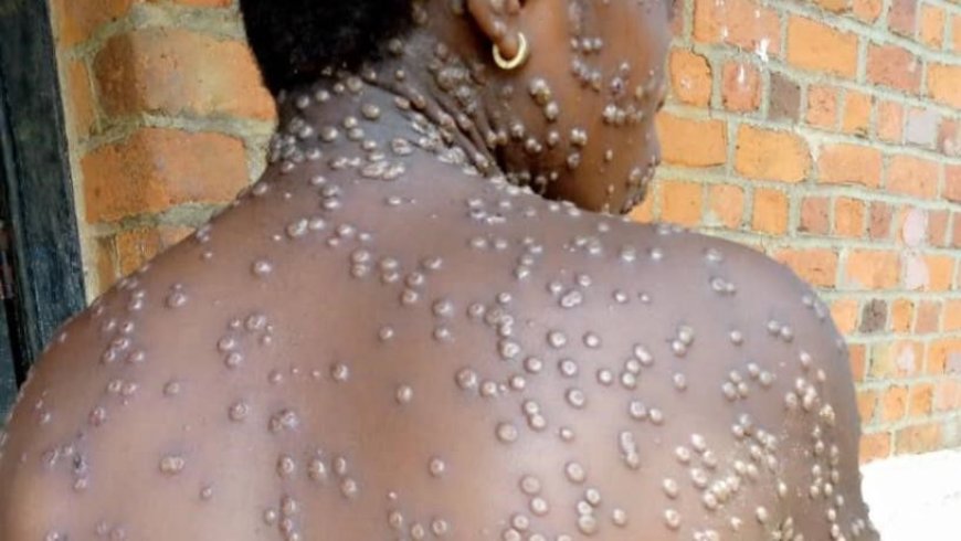Ghana's Mpox Outbreak Worsens: 302 Cases, 20 New Infections
