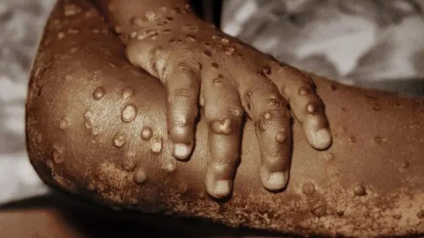 Ghana's Mpox Count Hits 346 as 18 New Cases Confirmed, No Fatalities Recorded