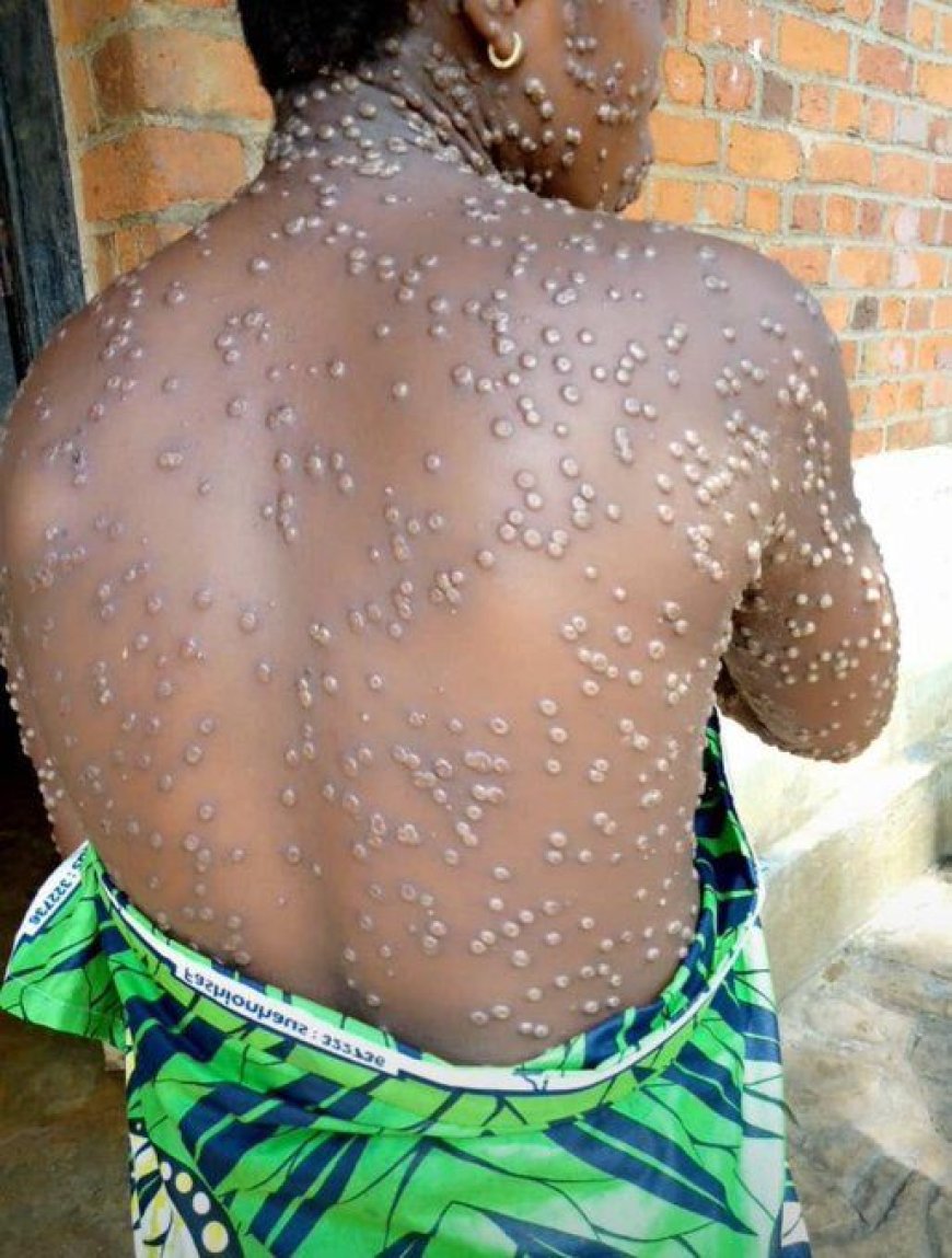 Health Alert - Ghana's Mpox Cases Surge to 409 with 37 New Infections