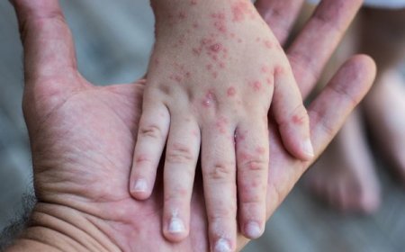 Measles Outbreak: US Faces Unprecedented Health Crisis with 1,300 Cases and Counting