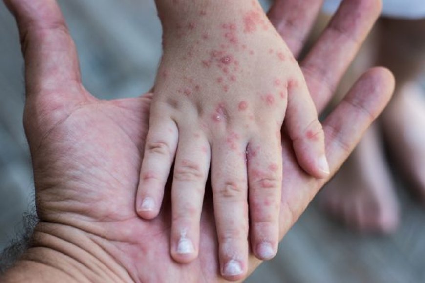 Measles Outbreak: US Faces Unprecedented Health Crisis with 1,300 Cases and Counting